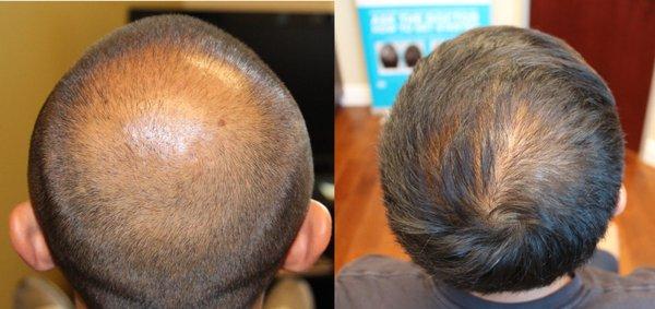 Patient underwent an FUE procedure to add density into his crown.