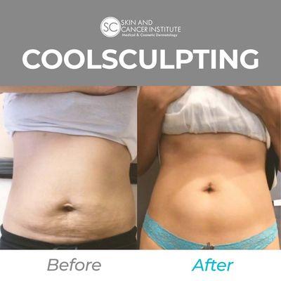 Cool Sculpting