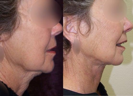 Neck Lift