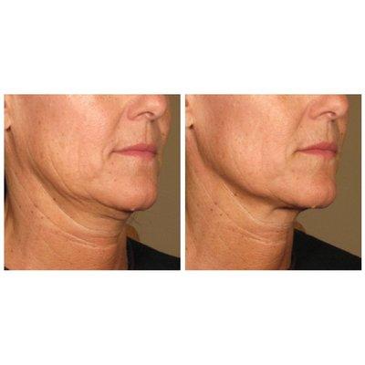 Lower Face Ultherapy Treatment (non-surgical lift)