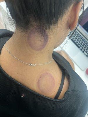 Cupping Therapy