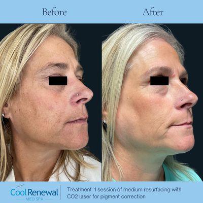 Before and After Skin resurfacing.