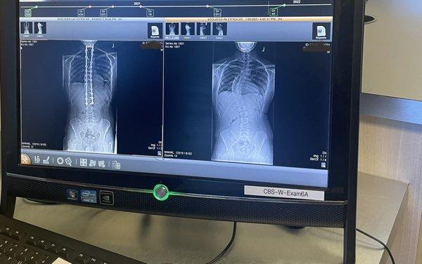 Before & After spinal fusion surgery performed by Dr. Karen Myung M.D.