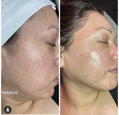 Before and After Dermaplaning