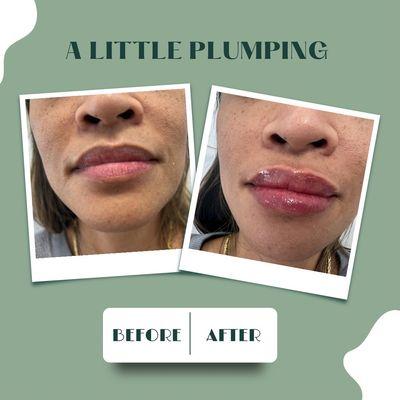 Before and After Juvederm Lip Filler