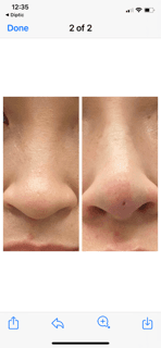 Euro Thread non surgical nose job