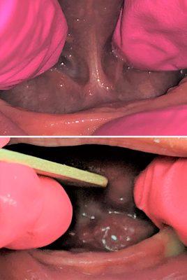 Before & After tongue tie