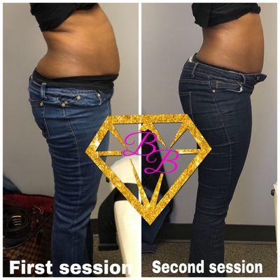 One laser lipo service