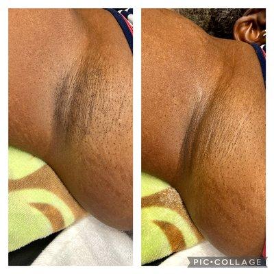 Underarm Sugaring after 6 weeks of hair growth.