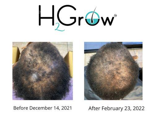 JRS hair loss Clinic results of H2Grow Rejuvenation system