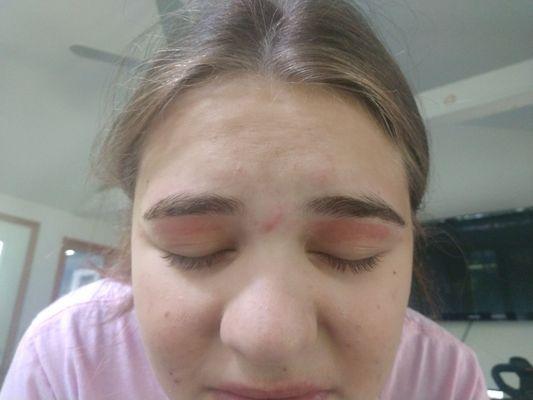 My daughter's brows about an hour after a wax!  Very painful and obviously burned!  Would not return!