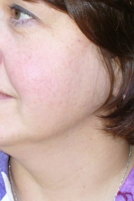 Acne Treatment - successful acne treatment - www.TransformationsSkinCenter.com Charlotte NC