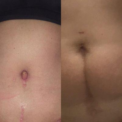 6 weeks post op pic of scar revision/ tummy tuck procedure before and after. I knew going in I would still have some scar.