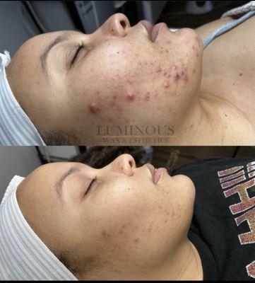 Acne Bootcamp