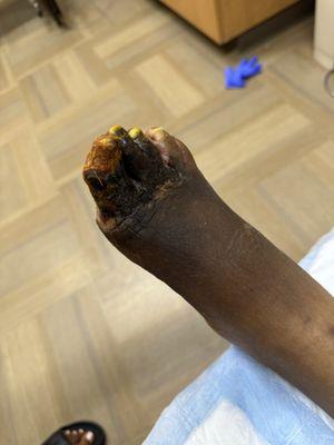 Dry gangrene and dead flesh