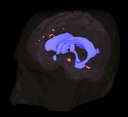 This model was made using a volume T1 MRI and a Fluid-attenuated inversion recovery (FLAIR) MRI...