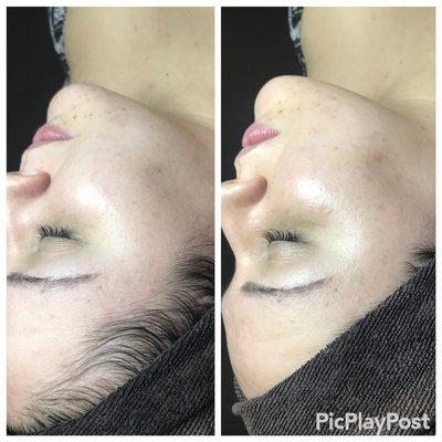 DermaPlane Luxury Facial