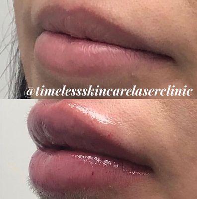 Lip Augmentation Before + After