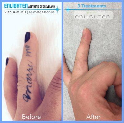 Enlighten Laser Tattoo Removal.