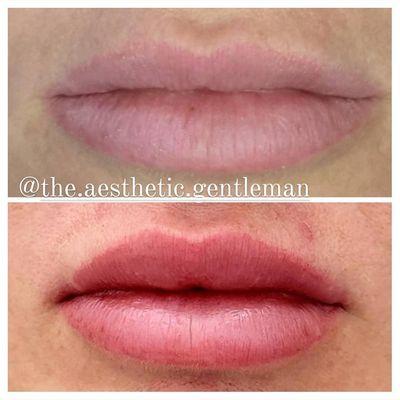 Lip hydration is what you need and can achieve with lip filler!