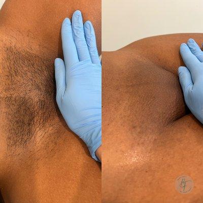 Brazilian sugaring before and after using sugaring paste