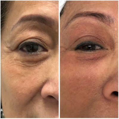 Upper eyelids lift after 2 treatments.