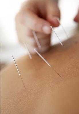 Acupuncture aids in healing, pain relief, stress relief, and more.