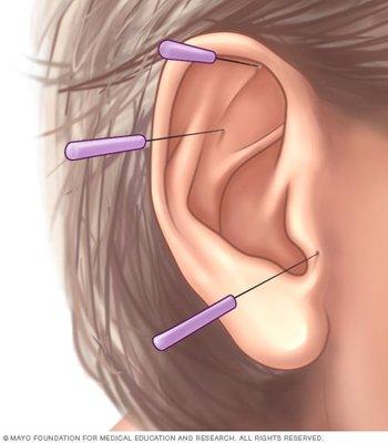 Ear acupuncture help