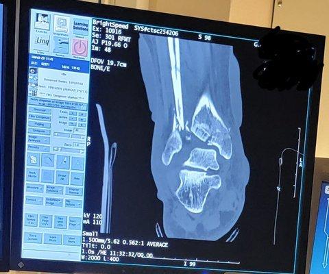 CT Scan of rear of right foot