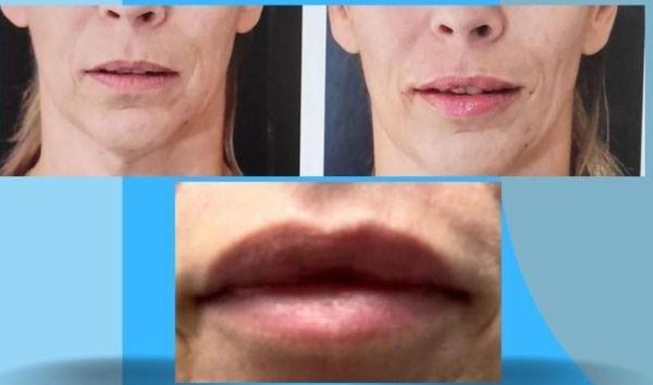 subtle lip enhancement