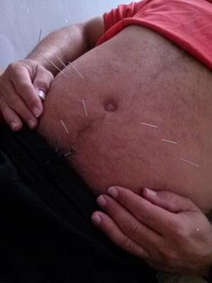 Weight Loss Acupuncture