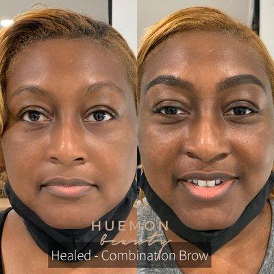 Healed combination brow