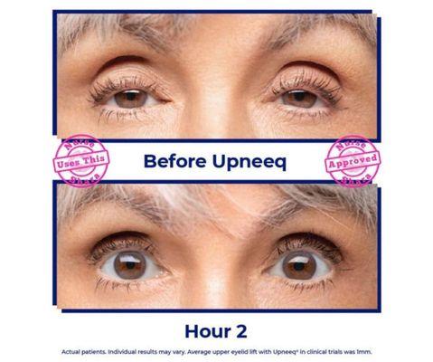 Upneeq prescription eyelid lifting. Look refreshed and vibrant, never go a day without it, just like your makeup.