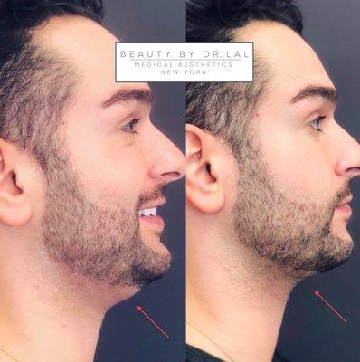 Our patient before and 6 weeks after Kybella to the chin for jawline sharpening.