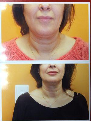 After 11 sessions, client did laser lipo on her chin.  She also reported that she lost inches on her stomach and her thigh too.