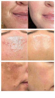 BioRePeel B & A. A peel that doesn't put your social plans on hold! Summer safe.