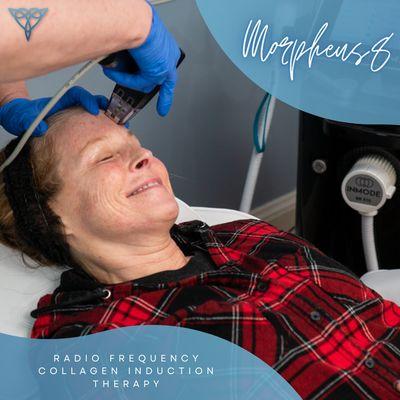 Morpheus8 RF Microneedling is state of the art