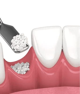 Bone Grafting services