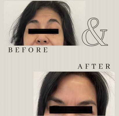 Botox to smooth out forehead lines