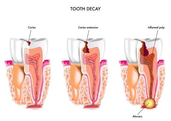 Emergency dentist Arlington TX, Gentle, Painless and Friendly Dentist. No More Pain, FREE Consultation & Flexible Payments (817) 462-0007