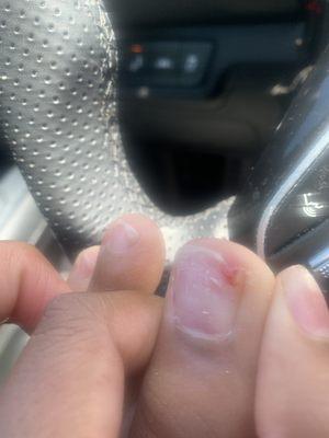 The toenail they pop the acrylic off of which caused a chunk to skin plus nail to rip