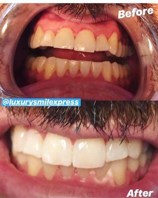 Before and after done by Luxury Smile Xpress.