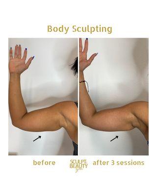 Body Sculpting (Arm Session)