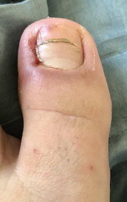 Toe day after surgery (10/14/17) left side of toe is where surgery was done.   Note: light clear discharge is normal after surgery