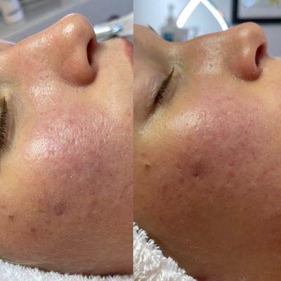 Before and after scar removal