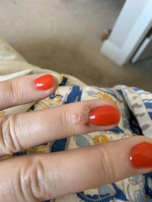 Infection from having a 'Dip' manicure.