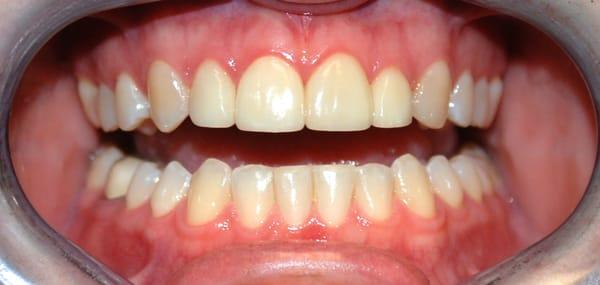 Beautify your smile with a set of veneers!