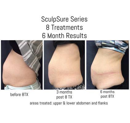 These results are great! Over a 6 month span, this patient saw AMAZING results with SculpSure! Mention this pic & get $100 off 1 treatment!