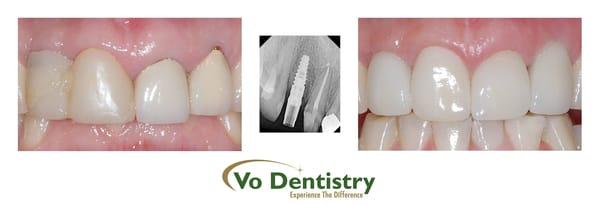 Implant Dentistry