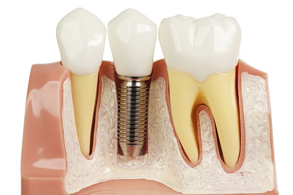 Dental Implant replace missing teeth by our specialists: Oral Surgeon and Prosthodontist